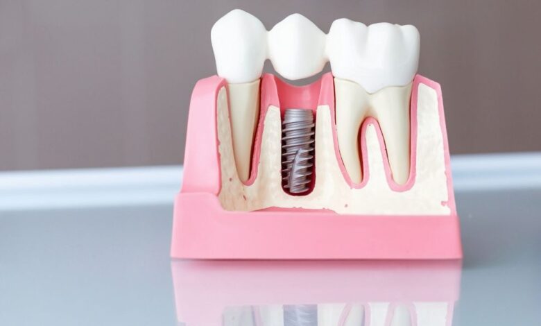 7 Common Mistakes in Cleaning Dental Implants and How to Avoid Them